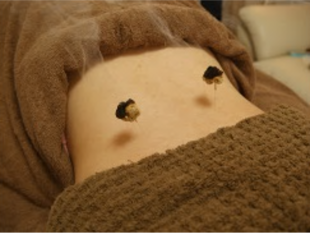 鍼灸治療、灸頭鍼、灸頭針