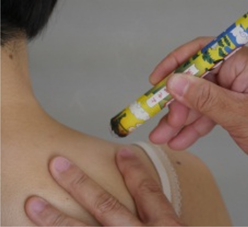 お灸治療（棒灸）